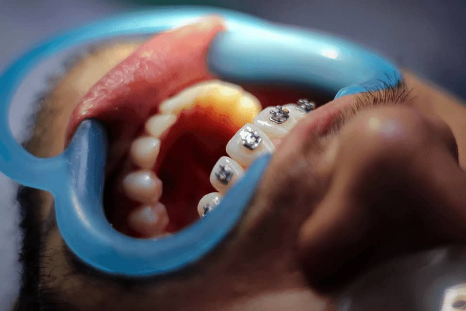 Braces benefit
