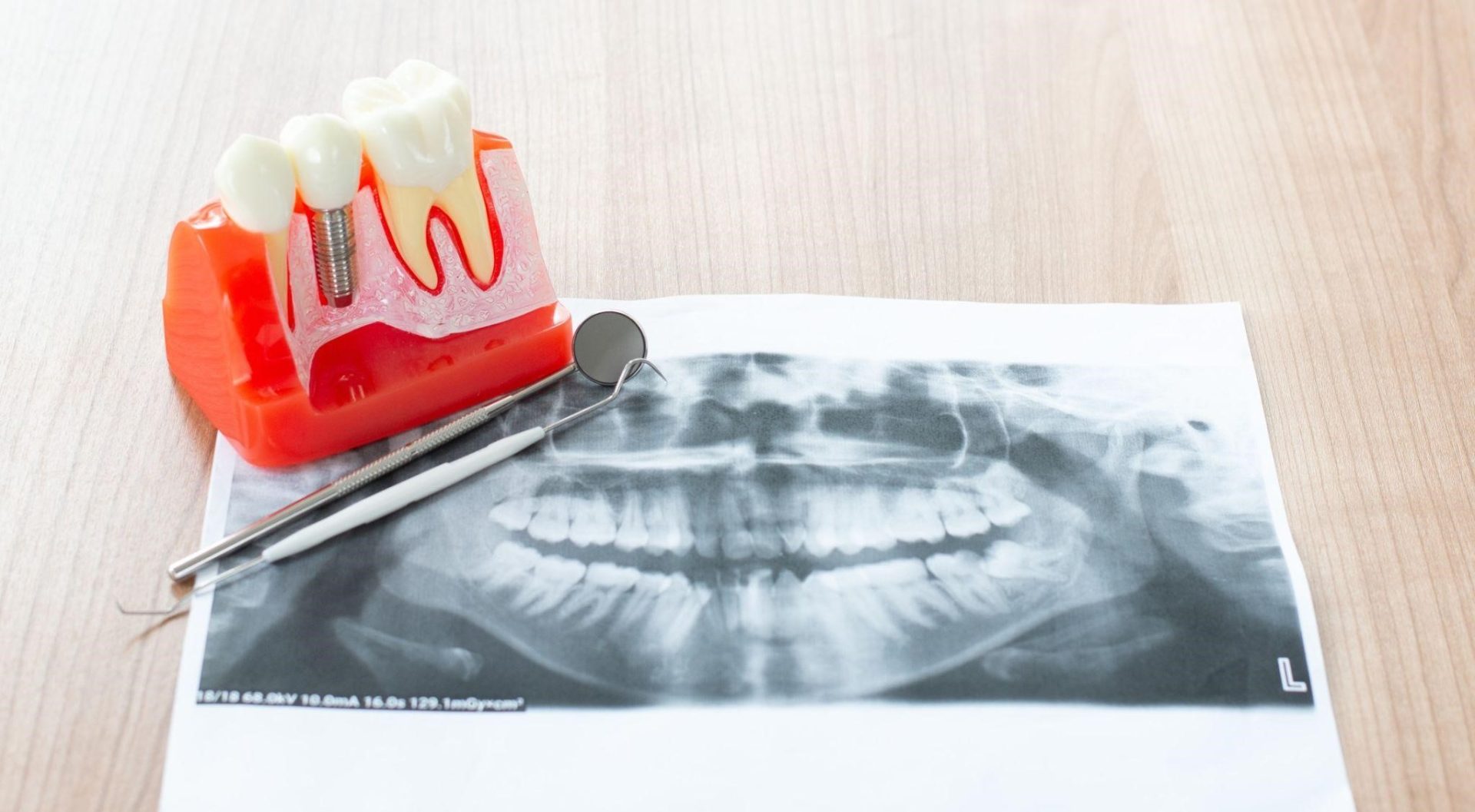 When Should You Consider Dental Implants