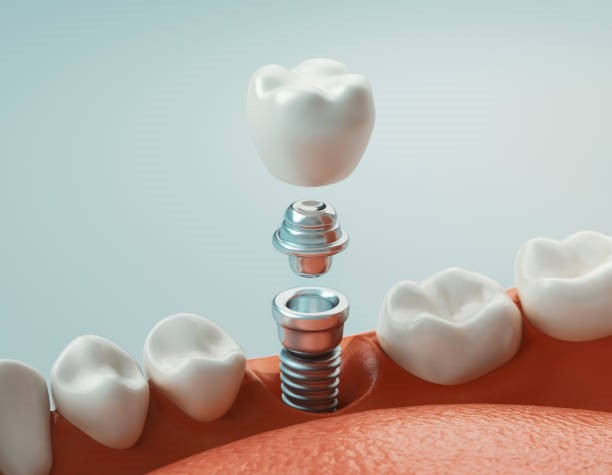 Dental Implants are Made of Titanium