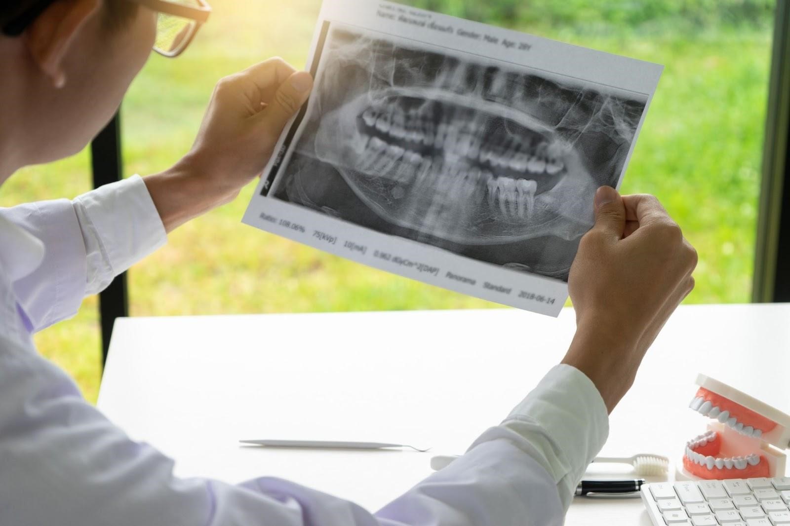 OPG X-ray Vs Traditional Dental X-ray - Smile Ville