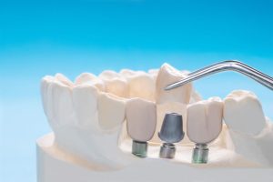 dental implant procedure last