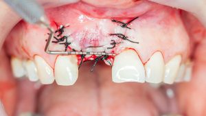 Bone grafting dental implants